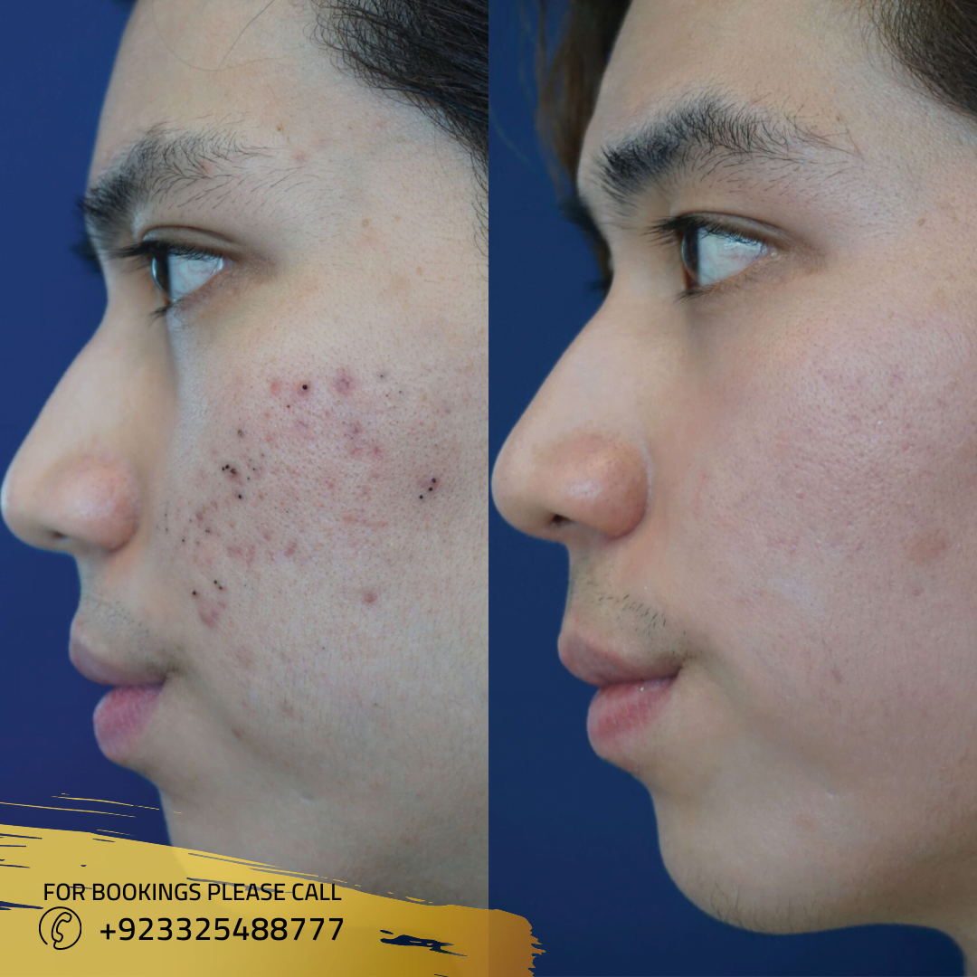 Acne treatment in Islamabad 