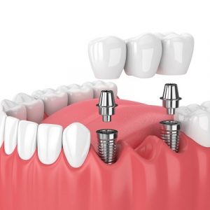 Cost of Dental Implants in Islamabad, Pakistan!