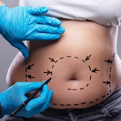 Best Liposuction Surgery in Royal Cosmetic Clinic