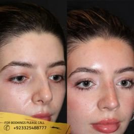 nose surgery before and after