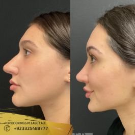 nose surgery cost in pakistan
