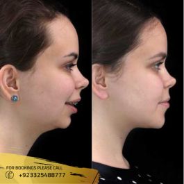 results of Jaw Surgery Cost in Pakistan