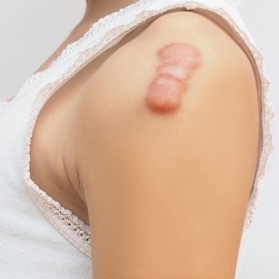 Keloid Treatment in Islamabad