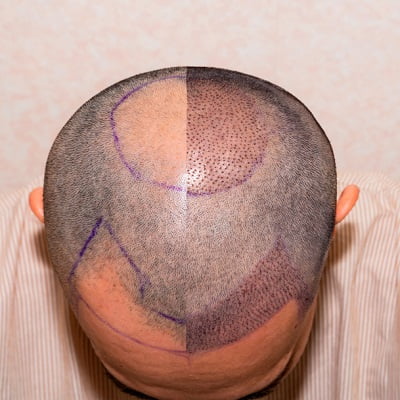 10,000 Grafts Hair Transplant Cost in Pakistan