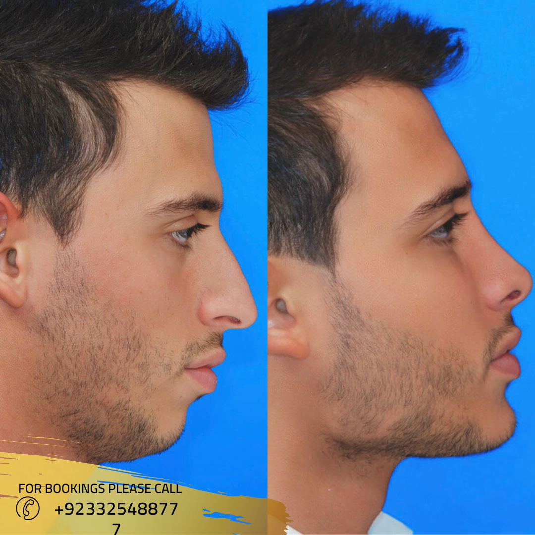 jaw-surgery-in-islamabad-rawalpindi-pakistan-maxillofacial-surgeon