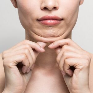 Does neck fat reappear after neck liposuction?