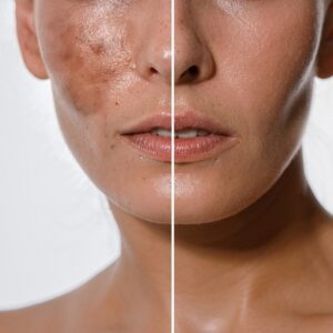 What treatment for hyperpigmentation works the quickest?