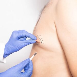 Treat gynecomastia with the right doctor