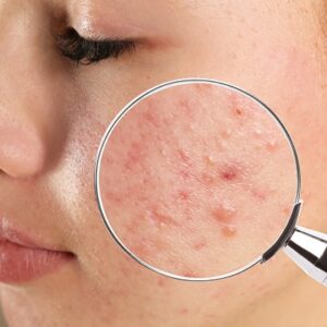 What Others Think About Acne Scar Treatment ? Is It Worth Your Money?