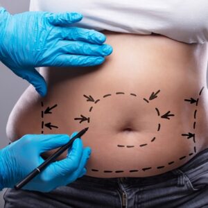 Liposuction Surgery : Facts vs Myths