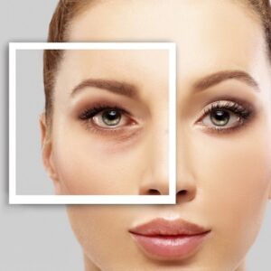 With Blepharoplasty, open your eyes to 2023!