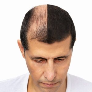 How Does Neografts Hair Transplant in Islamabad Works?