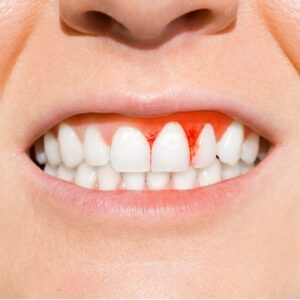 Dental Services -How To Prevent Periodontal Gum Disease?