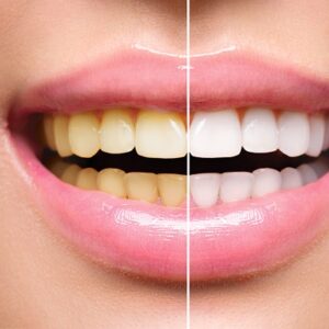 Is Teeth Whitening Safe?