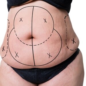 Liposuction and Cellulite: What You Need to Know