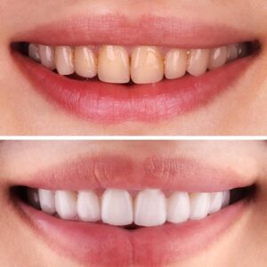 How to Maintain Your Teeth Whitening Results