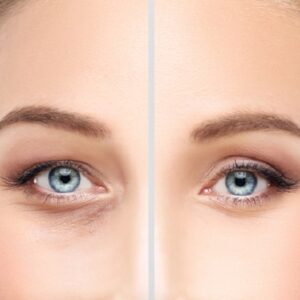 How long does the healing process from eyelid surgery take?