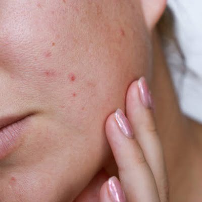 From Pimples to Perfection Expert Tips for Acne-Free Skin