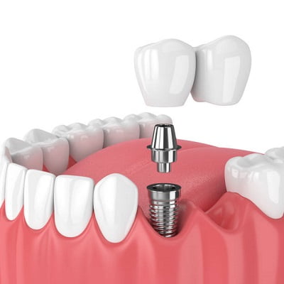 best crown for implants