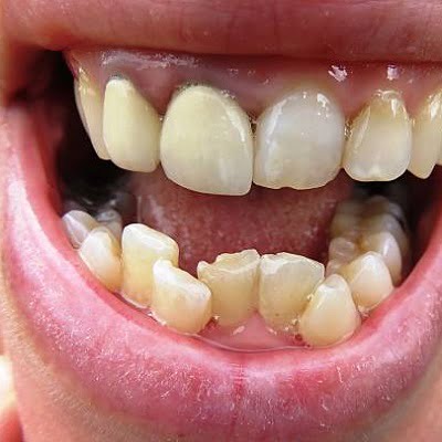 causes of protruding teeth