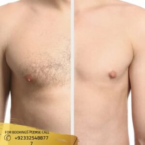 before after results of laser hair removal 