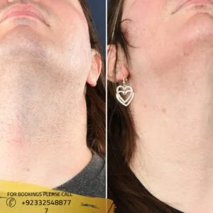 Laser Hair Removal in Islamabad RCS