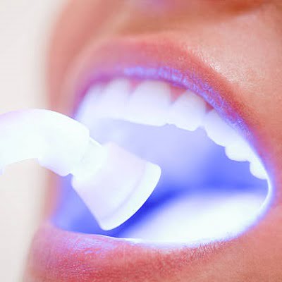 Do teeth become whiter after undergoing laser whitening