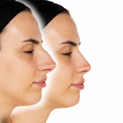 Elevate your profile with rhinoplasty solutions in Islamabad