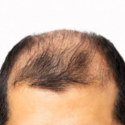 Does FUE crown hair transplant really transform your appearance?