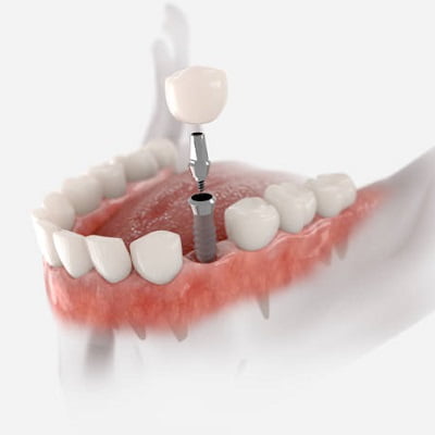 How many dental implants do I require?