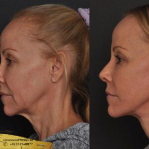 Result of facelift 