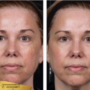 Hyperpigmentation Treatment before and after