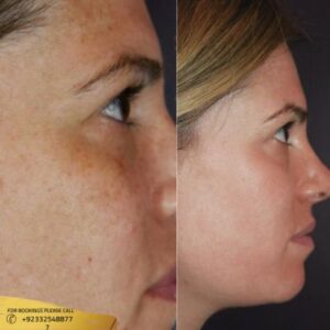 Hyperpigmentation Treatment cost in Islamabad