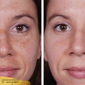 Results of Hyperpigmentation Treatment