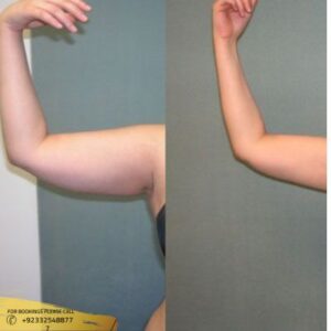 Arm Lift before and after