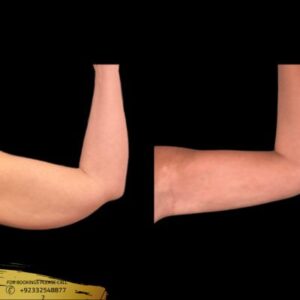 Results of Arm Lift