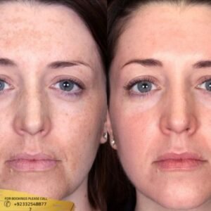 Results of Melasma Treatment