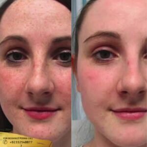 Melasma Treatment before and after