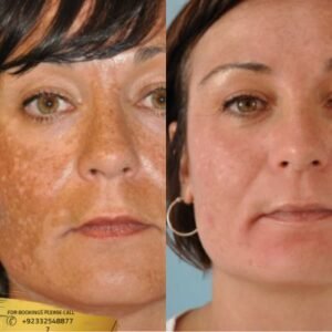Melasma Treatment cost in Islamabad