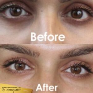 Dark Circles treatments cost in Islamabad