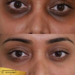 Dark Circles treatments before and after