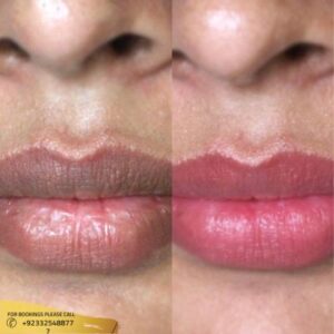 Results of Smoker Lips Treatment