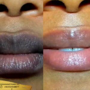 Smoker Lips Treatment cost of Islamabad