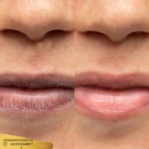 Smoker Lips Treatment before and after