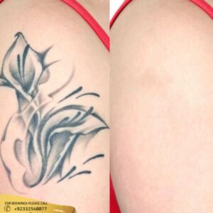 Laser Tattoo Removal before and after