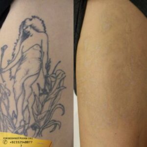 Results of Laser Tattoo Removal