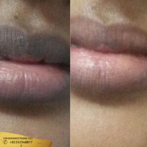 Lip Pigmentation Treatment before and after