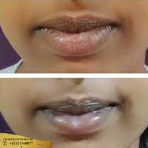 Results of Lip Pigmentation Treatment