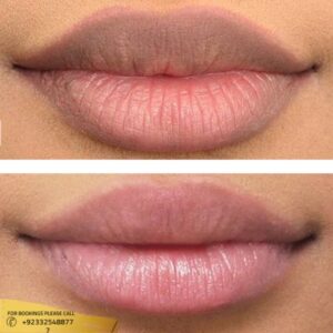 Lip Pigmentation Treatment cost in Islamabad