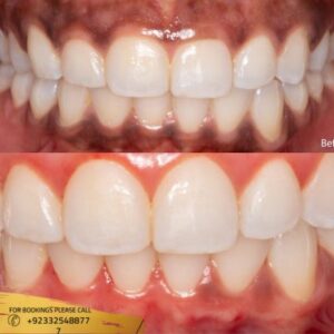 Gum Depigmentation before and after